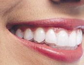 Apparecchi ortodontici invisalign